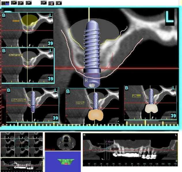 Das Bild zeigt eine Implantat-Planung