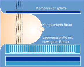 Das Bild zeigt wie eine Mammographie Untersuchung funktioniert