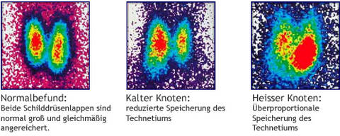 Das Bild zeigt arten von Knoten in der Schilddrüse