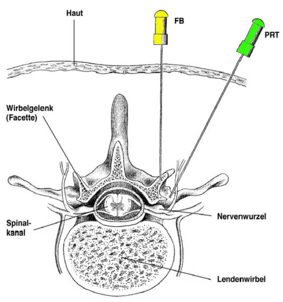 Das Bild zeigt wie eine Mammographie Untersuchung funktioniert