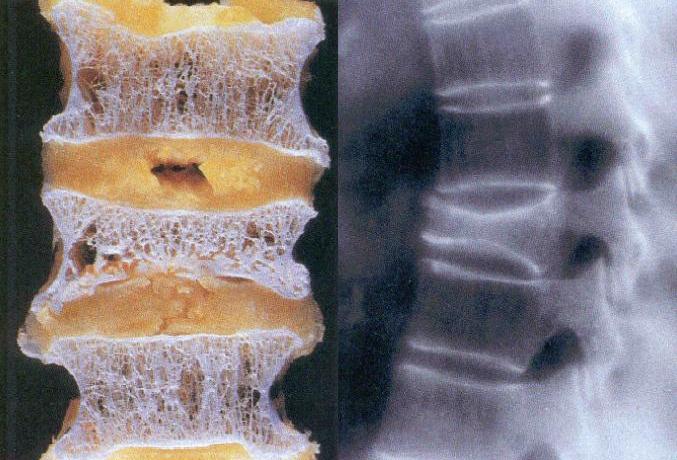 Das Bild zeigt das Innere eines Wirbels auf der linken Seite. Auf der rechten Seite zeigt es eine Röntgenaufnahme der Wirbelsäule.